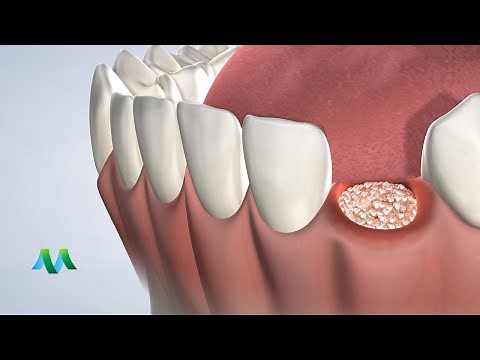 Socket Preservation in Flint MI | Greater Michigan Oral Surgeons & Dental Implant Center