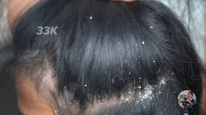 30K views · 311 reactions | Extreme Damage Dandruff on long hair guy - Itchy Dry scalp - Combing and scratching 788 | 33K | Facebook