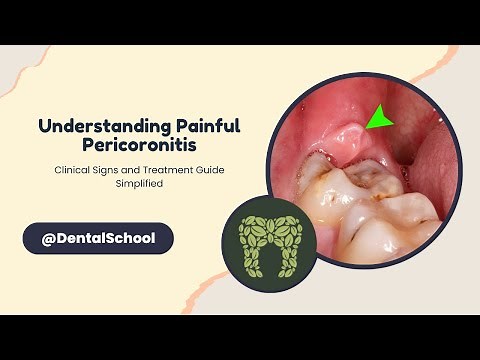 Pericoronitis Explained: Signs, Causes, and Definitive Treatment