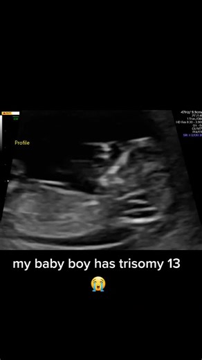 Understanding Trisomy 13 and Its Effects on Development