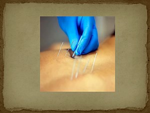 Benefits of dry needling in physiotherapy and its impact on recovery