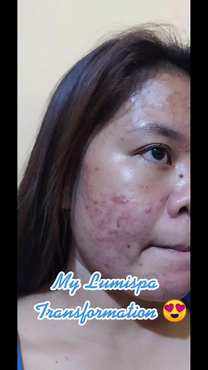 Transform Your Skin with Lumispa | Before and After Results