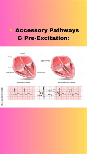 The EP Journey on Instagram: "Roughly 1 in 1000 people are born with an extra electrical connection between the atria and ventricles — called an Accessory Pathway or Bypass Tract. This extra pathway creates a shortcut that allows impulses to bypass the AV node, forming a re-entrant circuit between the AV node and the accessory pathway — sustaining an SVT (AVRT). 👉 The good news? Catheter ablation can target and eliminate the pathway — effectively curing the SVT. 📈 ECG Signs of an Accessory Pat