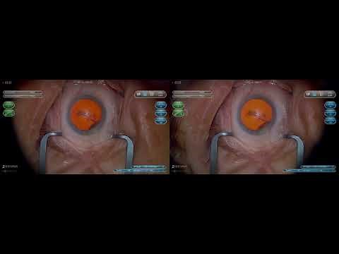 3D Surgery: Phacoemulsification for Beginners