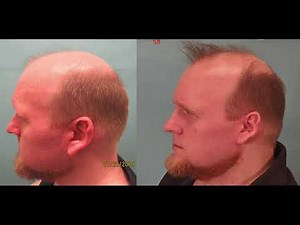 Extracellular Vesicles (EV) for Hair Growth - Patient's Hair Loss Journey