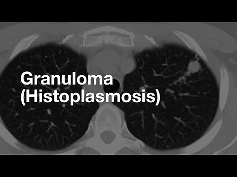 Classic Case: Granuloma from Histoplasmosis