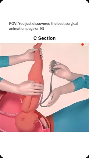 Animations on Instagram: "Follow @surgicalanimation for more! 🏥"