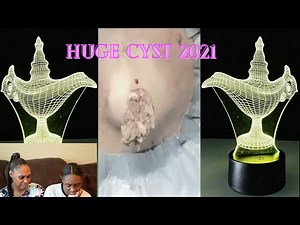 HOW TO REMOVE HUGE BLACKHEAD CYST 2021|REACTION