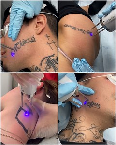 80K views · 242 reactions | That's how laser removal of tattoos goes... | Make-Up & Hair Tutorials | Facebook
