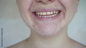 A young girl smiles and shows crooked teeth. The concept of dental problems. Stock Video