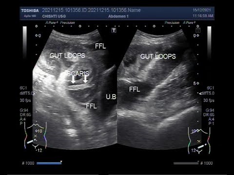 Intestinal Obstruction with Perforation.