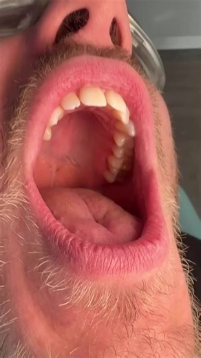 Using an ID brush from the lingual side. Have you tried this? #DentalHygienist