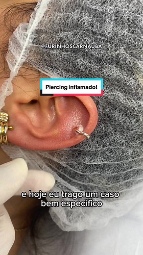 Tratando inflamação em piercings: Causas e Cuidados