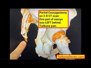 Partial Coccygectomy on 3-D CT scan: One part of coccyx was LEFT behind. Coccyx pain, Tailbone pain