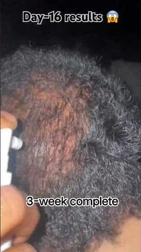 😱 Hair Growth Transformation | Minoxidil 5% Week 3 Complete 🔥