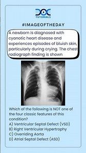 👉 Which of the following is NOT one of the four classic features of this condition?