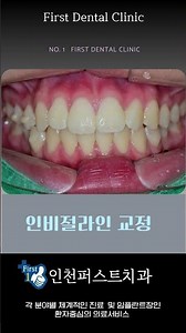 "티 안나게 달라지는 인비절라인 결과 실화?"#인비절라인전과후#교정추천#인천치과#연수구치과#남동구치과#교정전후#치아교정#투명교정#인비절라인#인천치과#자연스러운교정#교정기간