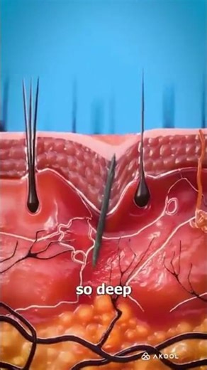 How Splinters Get Unstuck😲