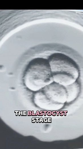 The ICSI procedure is a form of in vitro IVF used to treat infertilty caused by male factor issues ivfjourney#malefactorinfertility#ivf#relatable#ttccommunity | Leah Marie