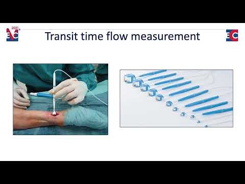 Transit Time Flow Measurement (TTFM) Explained by Dr. Meyer
