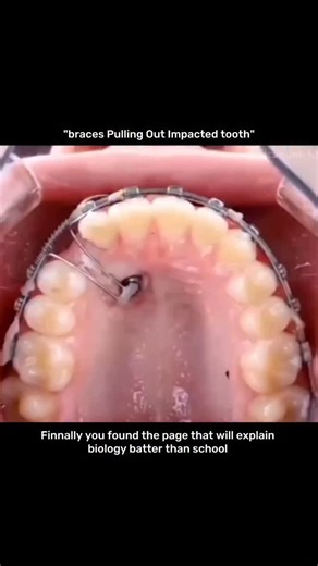 MEDICAL / BIO / SCIENCE on Instagram: "“Braces pulling out an impacted tooth” sounds intense, but it’s actually a smart mix of biology and gentle physics 🦷✨ An impacted tooth is stuck inside the jawbone or gums and can’t erupt on its own. Orthodontists first create space with braces. If needed, a small surgical exposure reveals the tooth, and a tiny bracket or chain is attached. From there, controlled, continuous force is applied through the braces. This slow pull triggers bone remodeling: bone