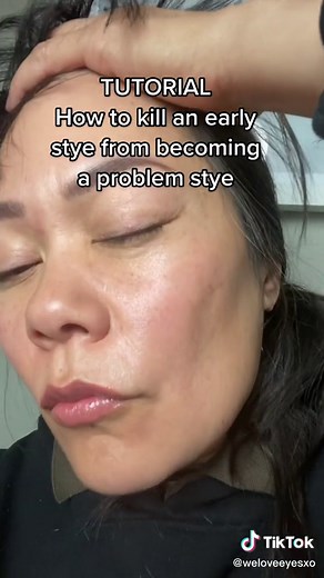 Early Stye Prevention and Treatment Tutorial
