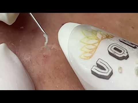 Acne Treatment New 2025 | Blackheads & Whiteheads Removal Mimi channel 034