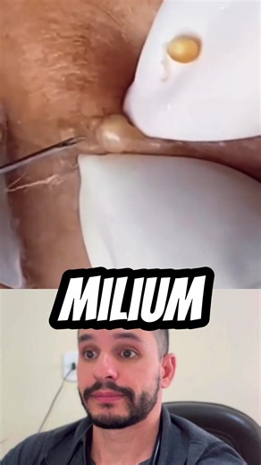 O que é Milium e como tratar?