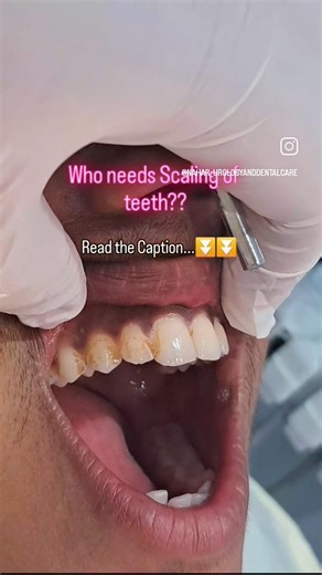 Daant safayi # teethcleaning whitening #teeth scaling# shorts #ytshorts #dentist #Dental reels#