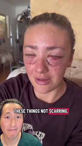 Where incisions are placed in lower eyelid surgery