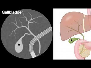 ERCP-Basics for Nurses & Techs - audio review from NoteBookLM