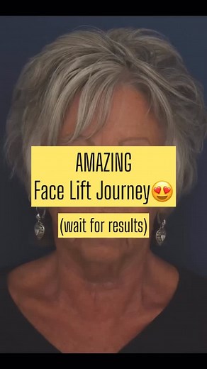 16 reactions · 6 comments | An incredible facelift transformation ✨ This journey included a Facelift, Mini Temporal Lift, and Chin Implant — and the results are stunning. ☎️ 410-902-9800  CosmeticSurgeryBaltimore.com #Facelift #MiniTemporalLift #ChinImplant #FacialRejuvenation #BeforeAndAfter #PlasticSurgeryJourney #BoardCertifiedSurgeon #AestheticMedicine | Ronald Schuster, MD - Cosmetic Surgery Baltimore | Facebook