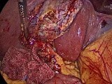 Retrograde Cholecystectomy • Video • MEDtube.net