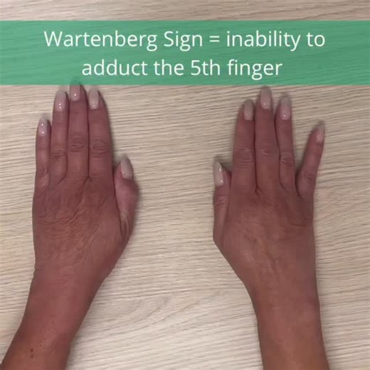 neuro on Instagram: "Wartenberg sign is a clinical sign seen in ulnar nerve palsy. It refers to involuntary abduction of the little finger (5th finger) when the hand is at rest or during finger extension. Why does it happen? (Pathophysiology) The interossei muscles (ulnar nerve–innervated) normally adduct the fingers. In ulnar nerve injury, these muscles become weak/paralyzed. The extensor digiti minimi (radial nerve–innervated) acts unopposed. ➡️ Result: the little finger drifts outward (abduct
