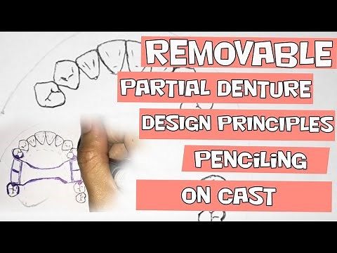 Removable Partial Denture Design- Penciling on Cast