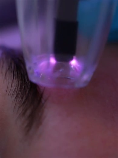 Cold Plasma: The Future of Facial Treatments in 2025