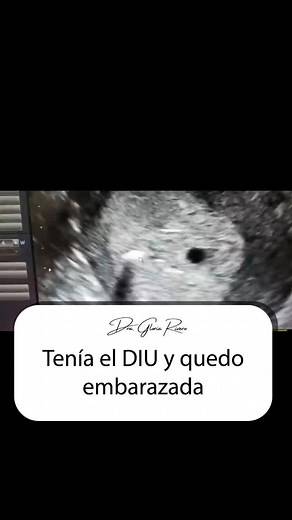 Embarazo con DIU: Síntomas y Consecuencias