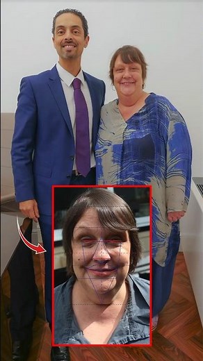 Kathy Burke's Golden Ratio facial analysis #facialsurgery #goldenratio #facelift