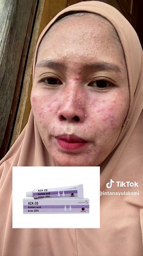 Pemakaian Mediklin TR Ungu: Purging, Irritasi, dan Efek Sampingnya
