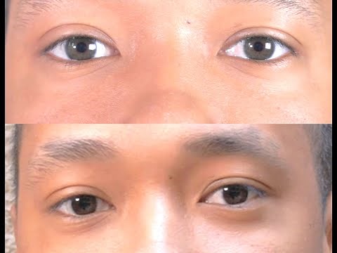 Change your eye color naturally with iREX Laser - Irex Laser