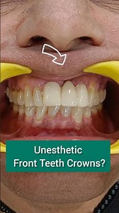 Unesthetic Front Teeth Crowns? 😬 Fix Your Smile Naturally | Dr. Srishti Bhatia #shorts #dentist