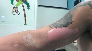 Virginia Teenager Hospitalized After Touching a Giant Hogweed Plant