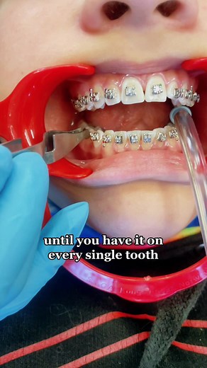 BracesByGrant on TikTok