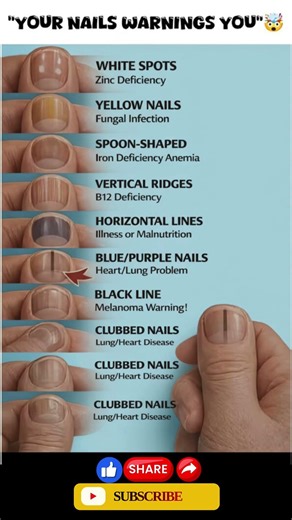 Your Nails Are Warning You – Don’t Ignore These Signs #healthylifestyle