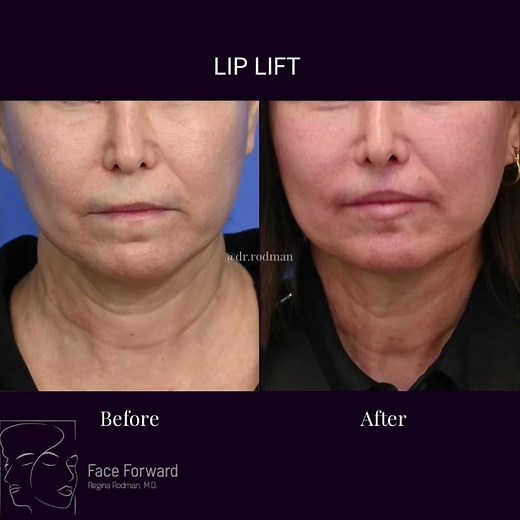 Lip Lift + Corner Lip Lift| Plastic Surgery| Before and After