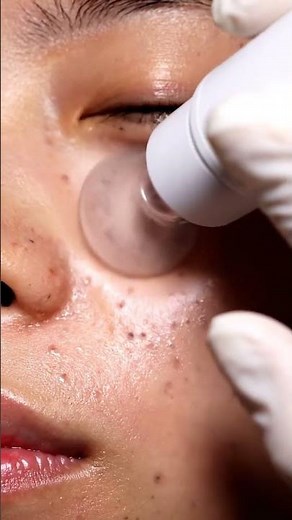 “Extreme Blackhead Suction Before & After — Clear Skin Results!”