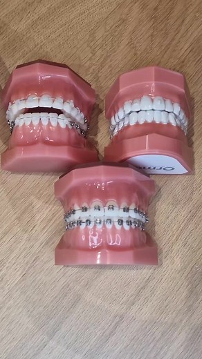 Tout savoir sur les dents du bonheur et le diastème