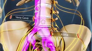 13K views · 341 reactions | Anterior lumbar interbody fusion (ALIF)...