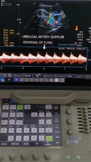 This Doppler finding is dangerous #Shorts #DopplerUltrasound #HighRiskPregnancy