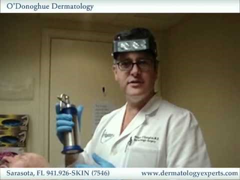 Treatment Of Pre-Cancerous Lesion With Liquid Nitrogen - O' Donoghue Dermatology, Sarasota FL
